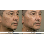 Kavvia Firm X RF Microneedling