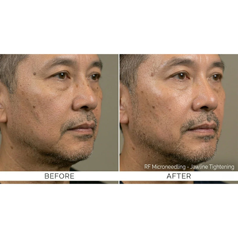 Kavvia Firm X RF Microneedling
