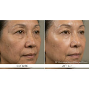 Kavvia Firm X RF Microneedling