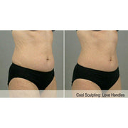 Kavvia CryoShape Cryolipolysis Body Contouring