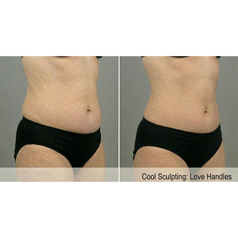 Kavvia CryoShape Cryolipolysis Body Contouring