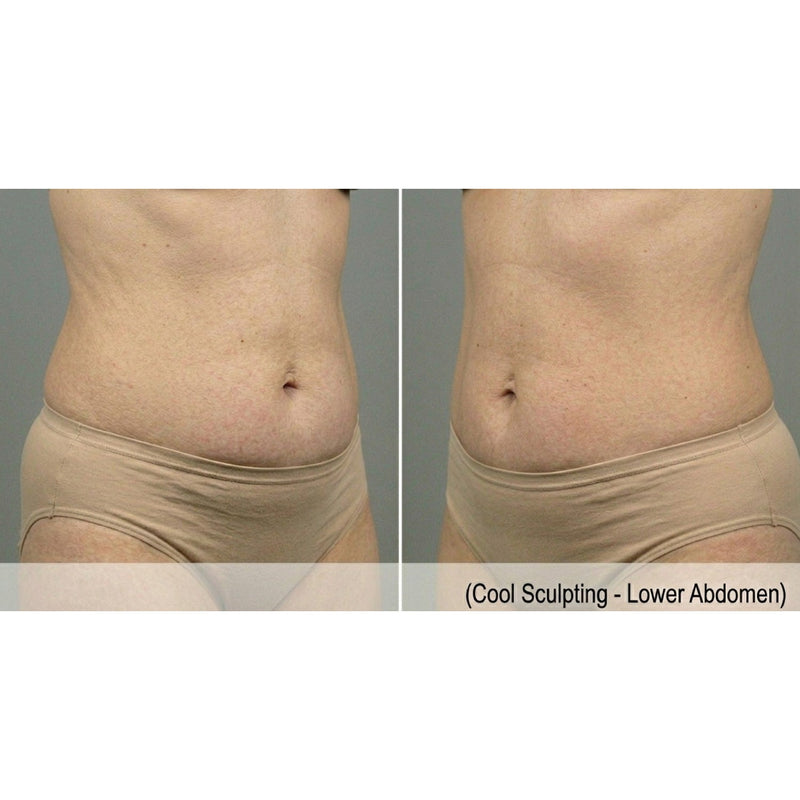 Kavvia CryoShape Cryolipolysis Body Contouring