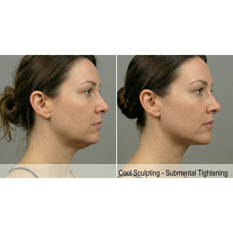 Kavvia CryoShape Cryolipolysis Body Contouring