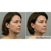 Kavvia Contour X HIFU Body Cavitation
