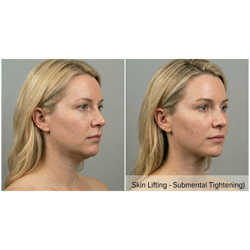 Kavvia Contour X HIFU Body Cavitation