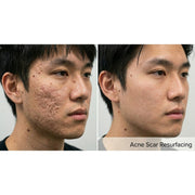 Kavvia Resurf CO2 Fractional Laser