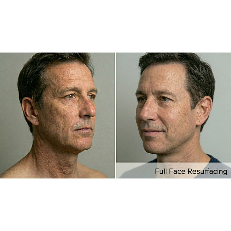 Kavvia Resurf CO2 Fractional Laser