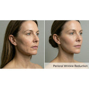 Kavvia Resurf CO2 Fractional Laser