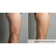 Kavvia Resurf CO2 Fractional Laser
