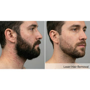 Kavvia DermaLux Diode Laser