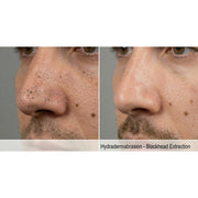 Kavvia HydraGlow Hydradermabrasion