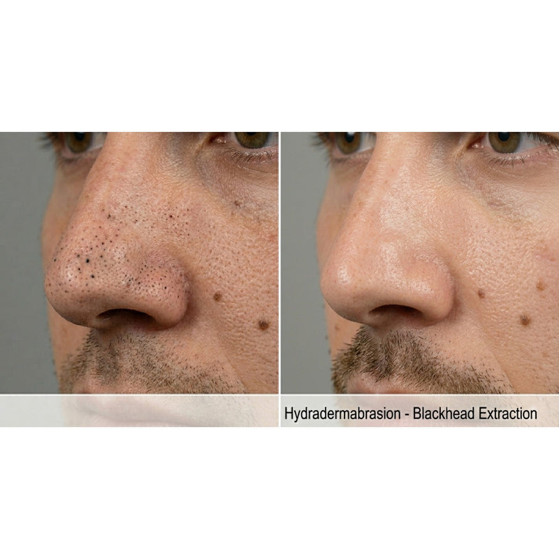 Kavvia HydraGlow Hydradermabrasion