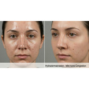 Kavvia HydraGlow Hydradermabrasion
