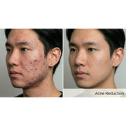 Kavvia Dualis X ND:YAG Laser
