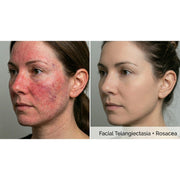Kavvia Dualis X ND:YAG Laser