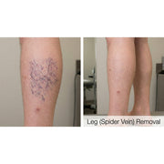 Kavvia Dualis X ND:YAG Laser