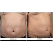 Kavvia Firm X RF Microneedling