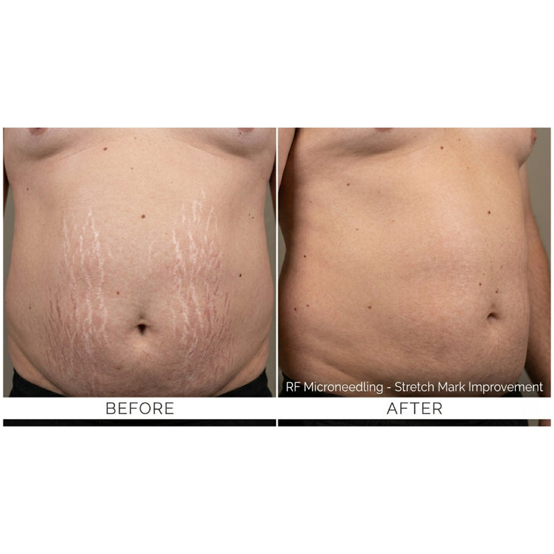 Kavvia Firm X RF Microneedling