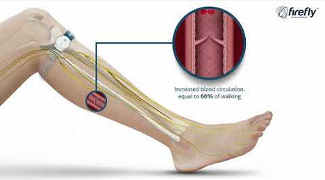 Firefly Recovery: How It Works — Recovery For Athletes